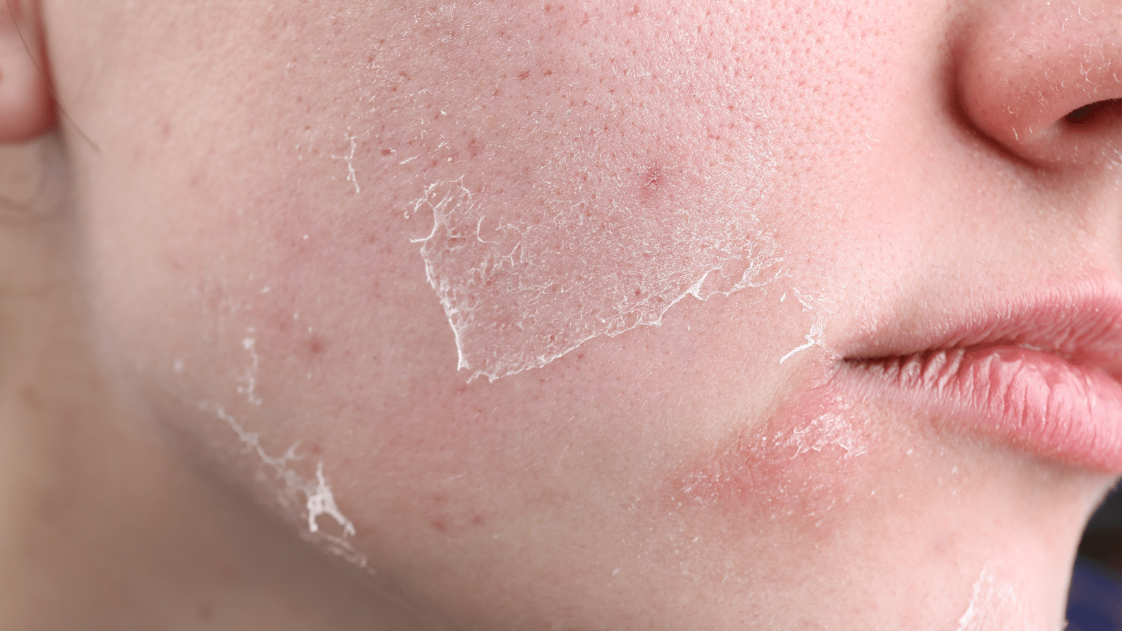 skin and hair dryness