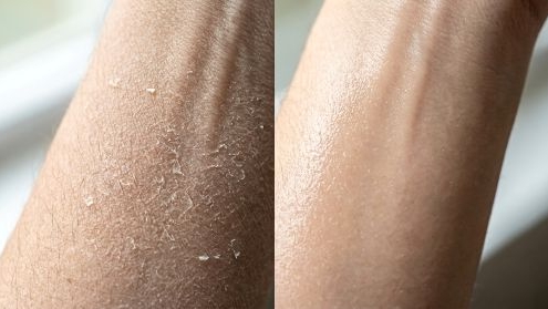 Hard water dry skin