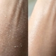 Hard water dry skin