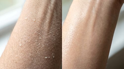 Hard water dry skin